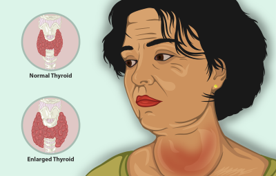 "goiter" picture