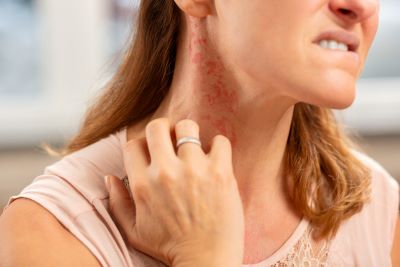 "allergy" picture