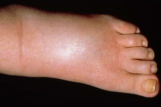 "swollen" picture