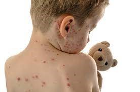 "measles" picture