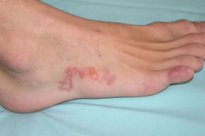 "hookworm" picture
