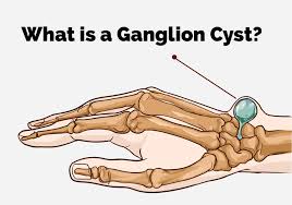 "ganglion" picture