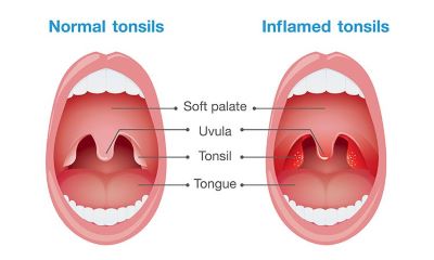 "tonsil" picture