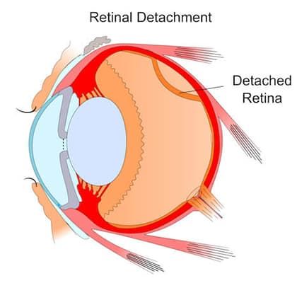 "retinal" picture
