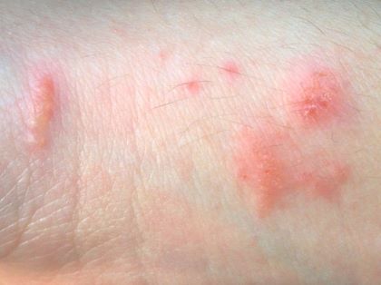 "blotchy" picture