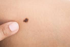 "birthmark" picture