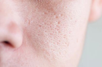"pore" picture