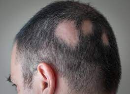"alopecia" picture