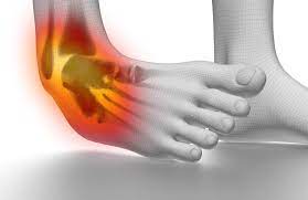 "sprain" picture