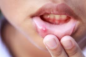 "ulcer" picture