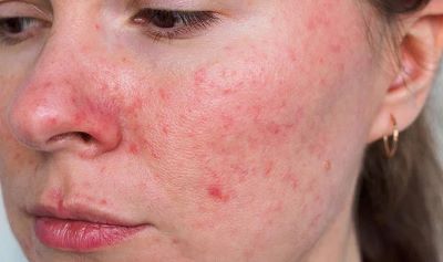 "rosacea" picture