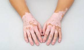 "vitiligo" picture