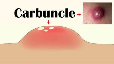 "carbuncle" picture