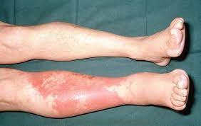 "cellulitis" picture
