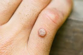 "wart" picture