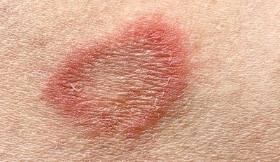 "ringworm" picture
