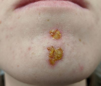 "impetigo" picture