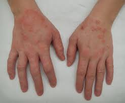 "dermatitis" picture