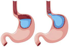 "gastro-oesophageal reflux disease" picture