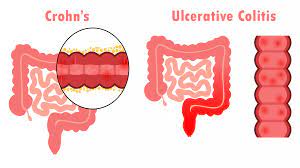 "ulcerative colitis" picture