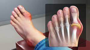 "gout" picture