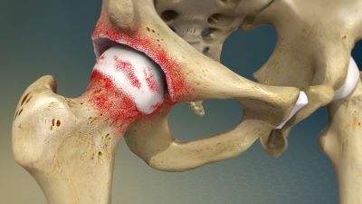 "osteoarthritis" picture