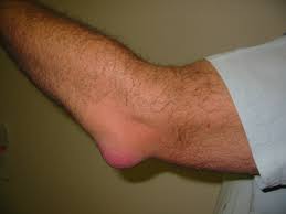 "bursitis" picture