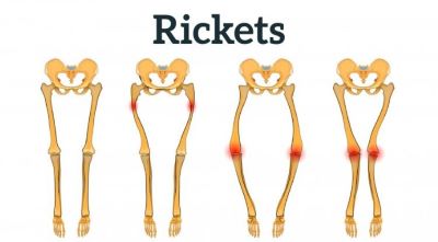 "rickets" picture