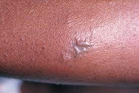 "gonorrhea" picture