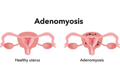 "adenomyosis" picture