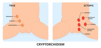 "cryptorchidism" picture