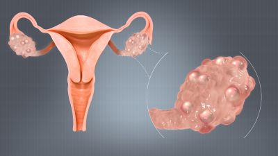 "polycystic ovary syndrome" picture