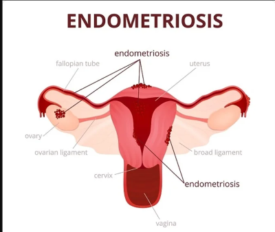 "endometriosis" picture