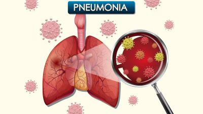 "pneumonia" picture