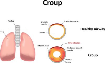 "croup" picture
