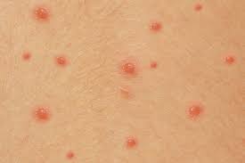 "chickenpox" picture