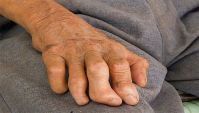 "leprosy" picture