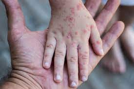 "rubella" picture