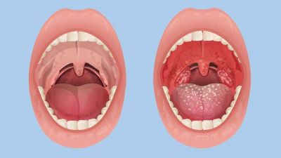 "tonsillitis" picture
