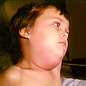 "mumps" picture