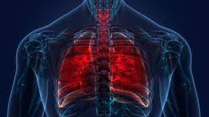 "tuberculosis" picture
