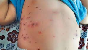 "typhus" picture