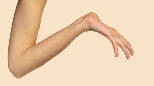 "Marfan syndrome" picture