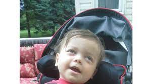 "Tay-Sachs Disease" picture