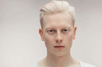 "albinism" picture