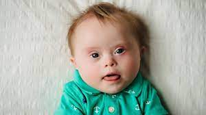 "Down syndrome" picture