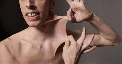 "Ehlers-Danlos syndrome" picture