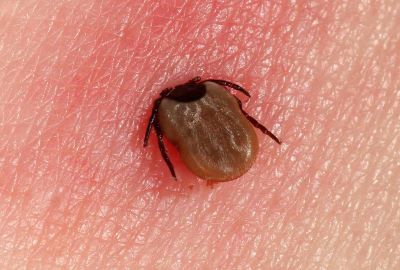 "Lyme disease" picture
