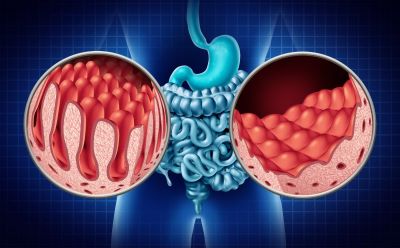 "celiac disease" picture
