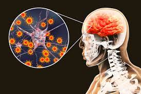 "encephalitis" picture